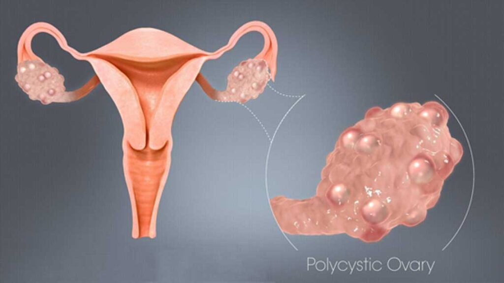 Natural ways to treat PCOS