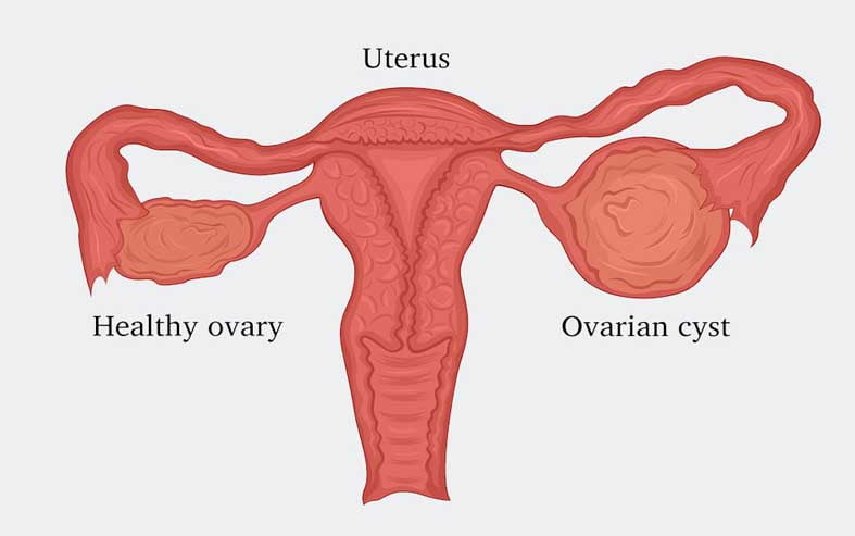 Different Types Of Ovarian Cysts