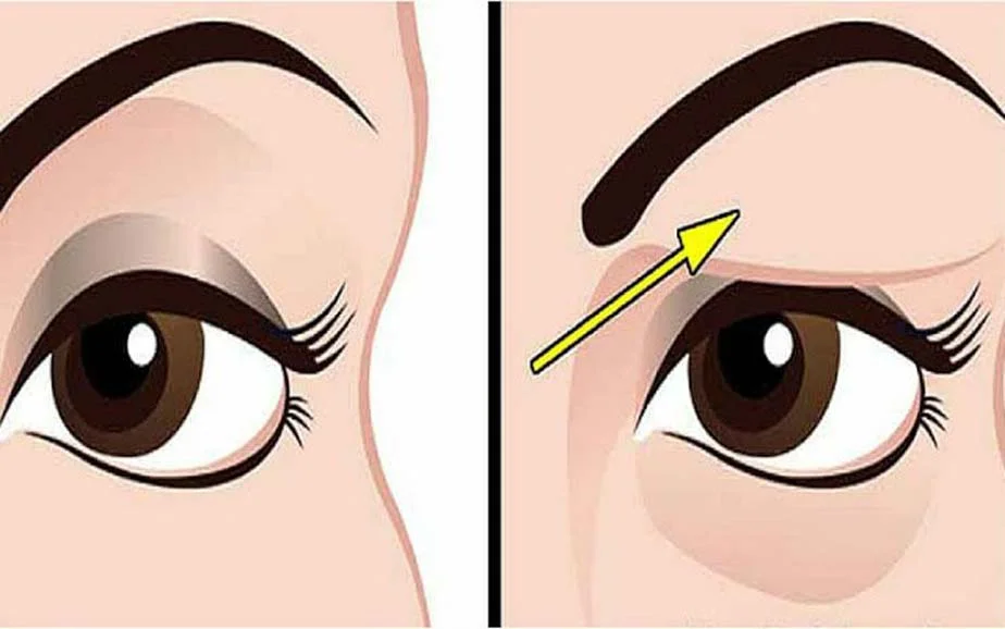 Causes of Droopy Eyelids