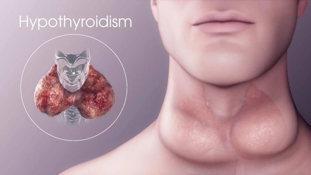 Estrogen Dominance and Hypothyroidism