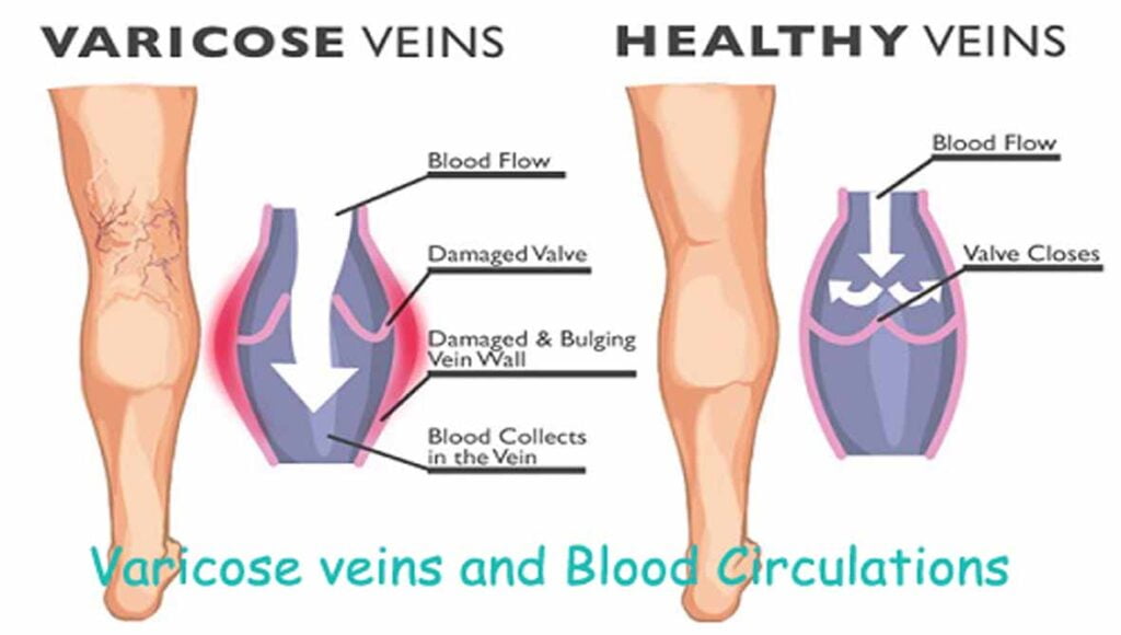 Does Obesity Cause Varicose Veins