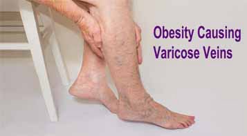 Obesity Causing Varicose Veins